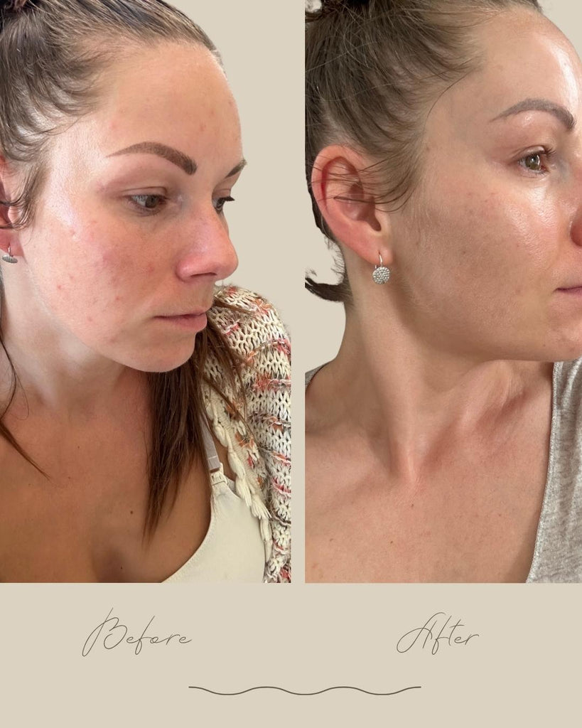 Acne isn't just about adolescence: what's really happening beneath the surface of your skin